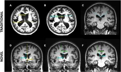 The Impact of Multimorbidity Burden, Frailty Risk Scoring, and 3-Directional Morphological Indices vs. Testing for CSF Responsiveness in Normal Pressure Hydrocephalus